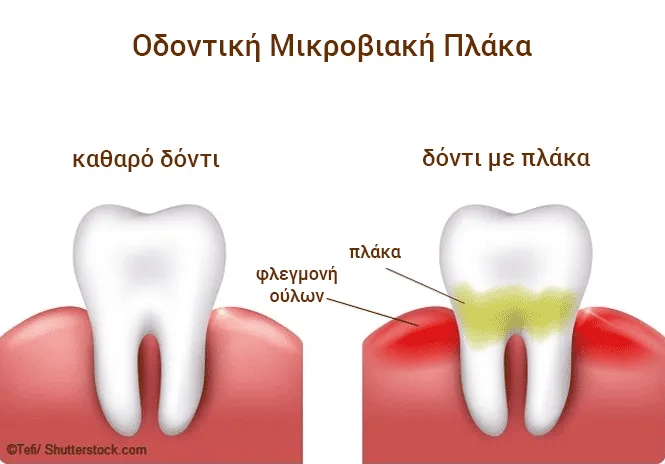 δόντι με πλάκα και φλεγμονή ούλων