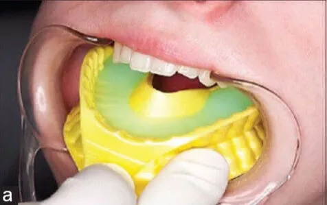φθορίωση από οδοντιατρο
