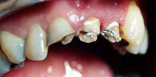 πρόσθια δόντια με απονευρώσεις