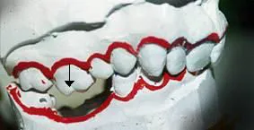 εκμαγείο δείχνει μετακίνηση δοντιού λόγω εξαγωγής