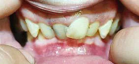 δόντια με υπερσύγκλειση