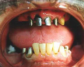 ενδοδοντικοί άξονες σε δόντια άνω και κάτω γνάθου