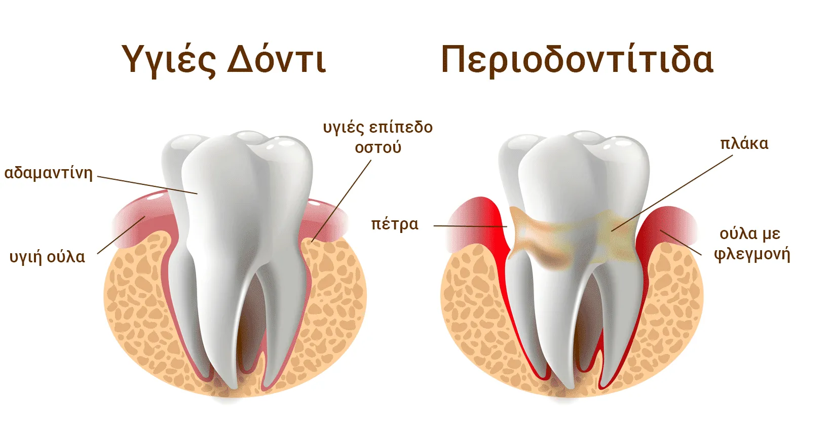 υγιές δόντι και περιοδοντίτιδα