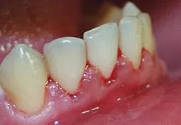 δόντια με ουλίτιδα